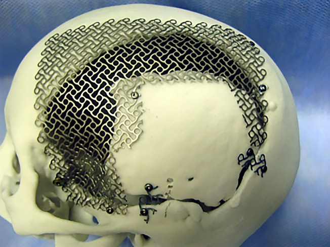 3D-печать протезов и имплантатов.
