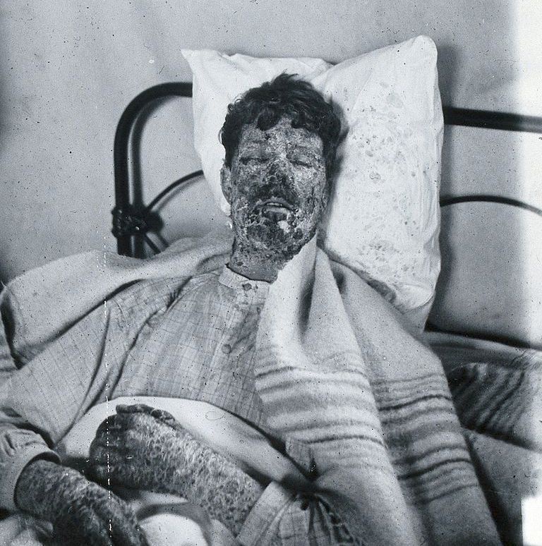 Больной оспой во время эпидемии в Глостере в 1896 году.