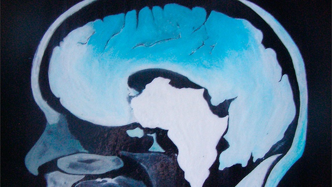 Ученые рассказали, как живут люди с половиной мозга