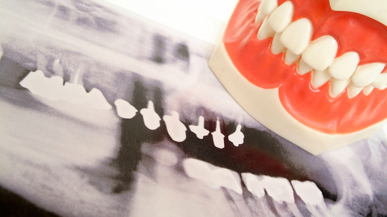 Раннюю потерю зубов связали с развитием деменции