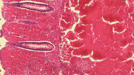 Бактерия-убийца надвигается на пляжи США и Средиземноморья